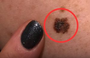 4 Types of Pimples That Could Be a “Disguise” for Can.cer