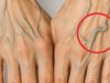 What causes veins to be more visible in hands at young age